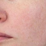 Tác hại của Retinol trên da nếu dùng sai liều lượng