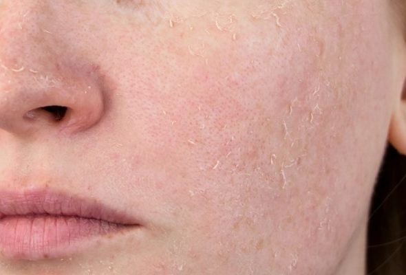 Tác hại của Retinol trên da nếu dùng sai liều lượng